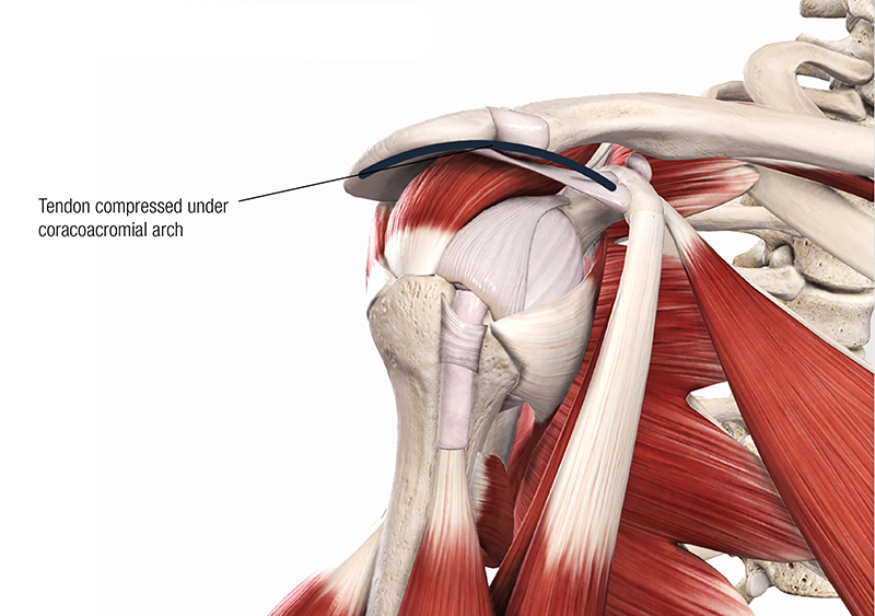 JA19_Bicipital Tendinopathy3 JA19_Bicipital Tendinopathy3