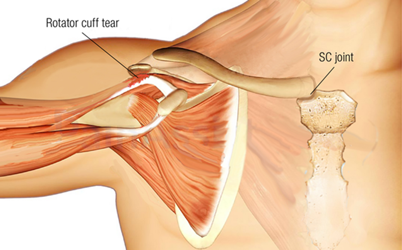 Don't Blame the Rotator Cuff Teaser Image Don't Blame the Rotator Cuff Teaser Image