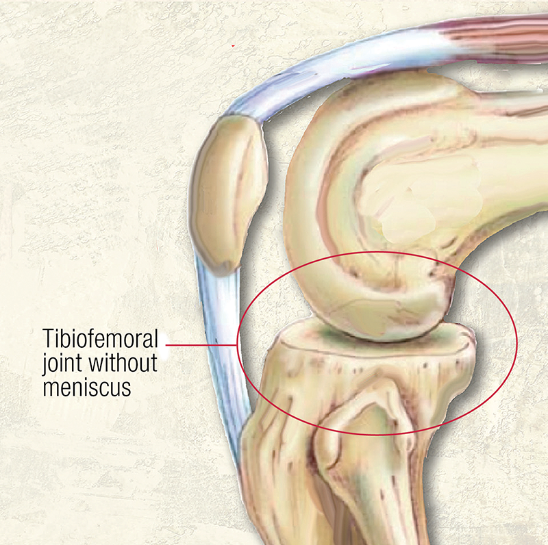 ND19_ Meniscus Tears2
