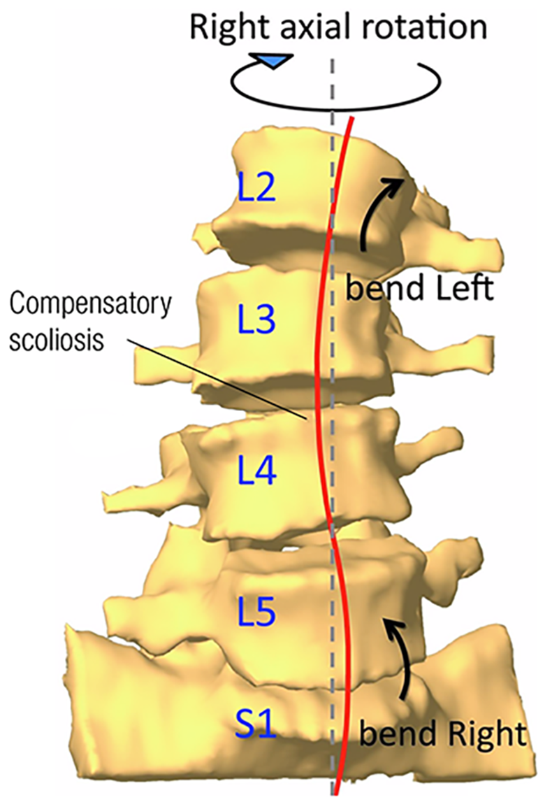 MA20 Scoliosis 2 MA20 Scoliosis 2