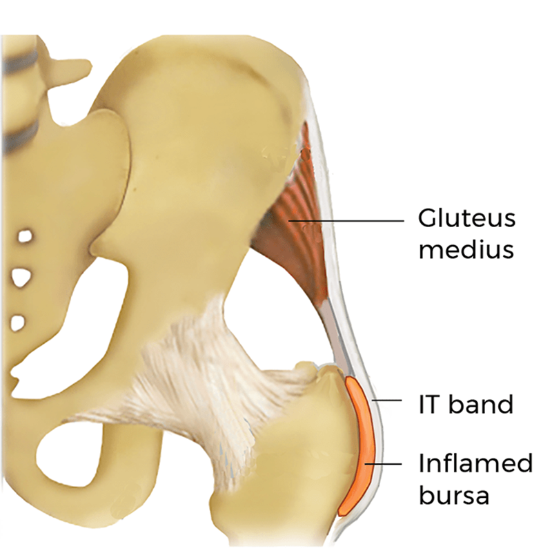 MJ21_DeepGlutealSyn4