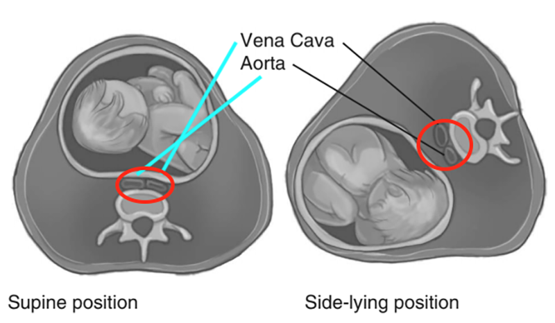 SO20_blood clots2 SO20_blood clots2
