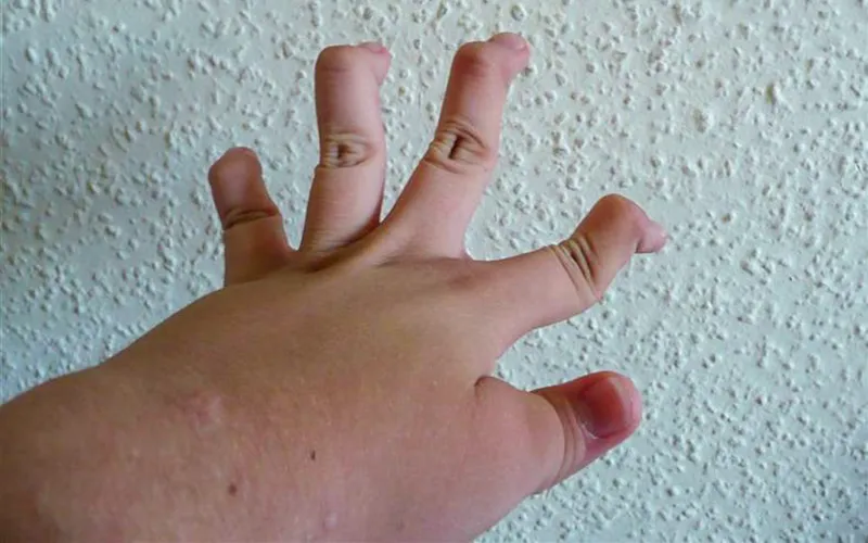 ND19_Ehlers-Danlos Syndrome1 ND19_Ehlers-Danlos Syndrome1